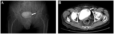 Primary pure large cell neuroendocrine carcinoma of the urinary bladder: a case report and literature review